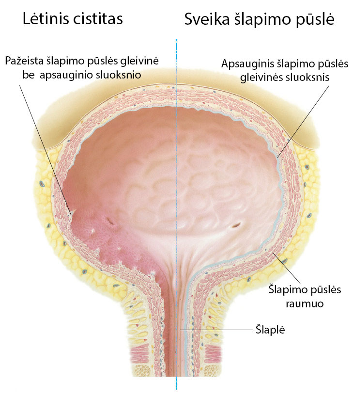 lėtinis cistitas
