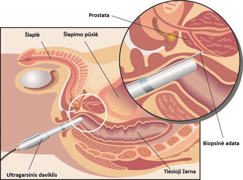 Prostatos vėžys - Prostatos biopsija