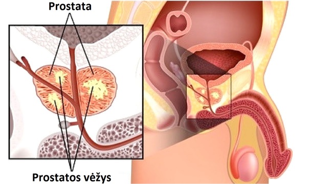 Prostatos vezys