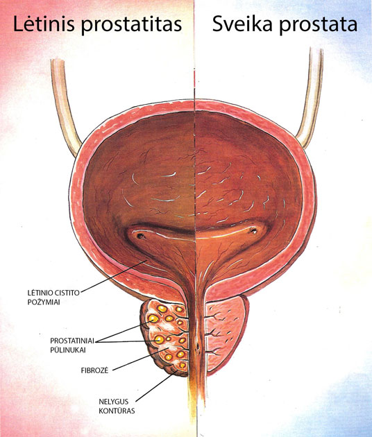 lėtinis prostatitas silpna erekcija