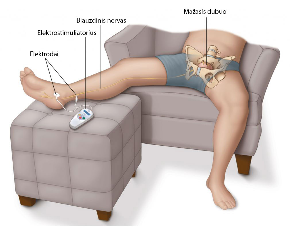 letinio prostatito gydymas neurostimuliacija