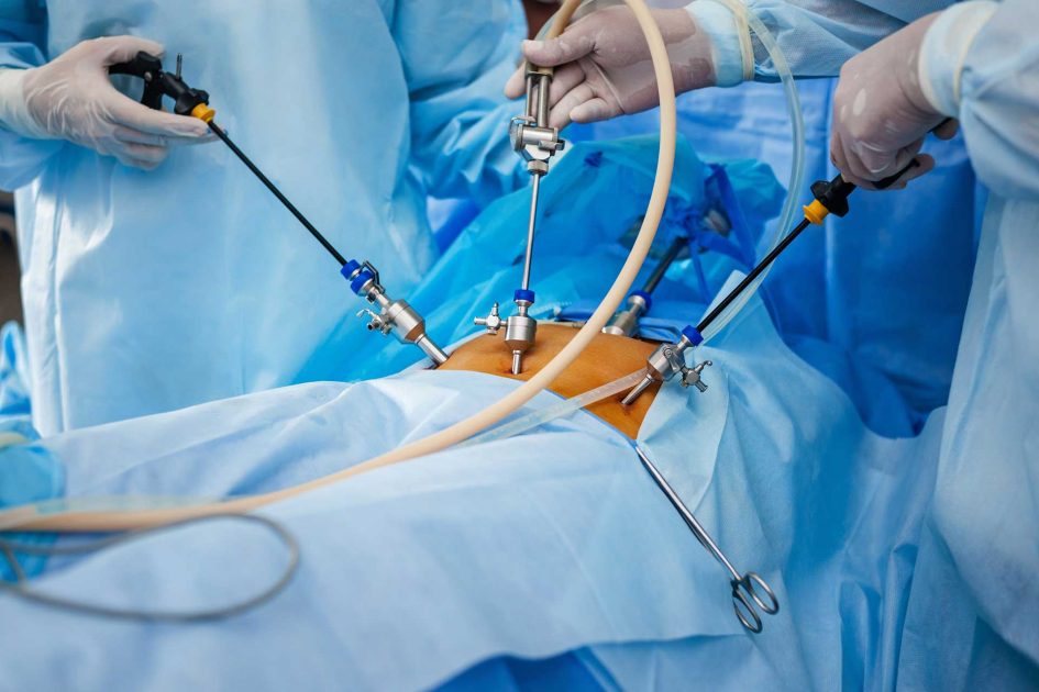 varikocelė laparoskopinė operacija