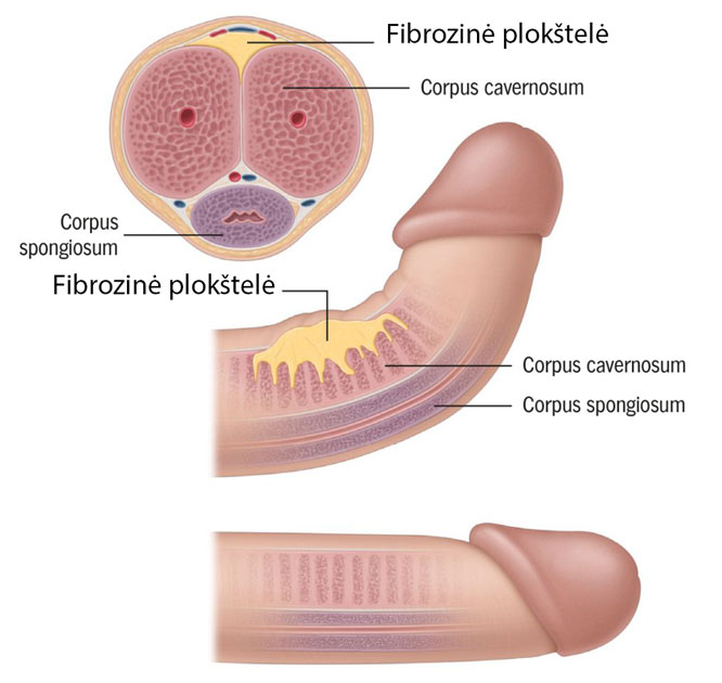 erekcija vyro lytinio organo