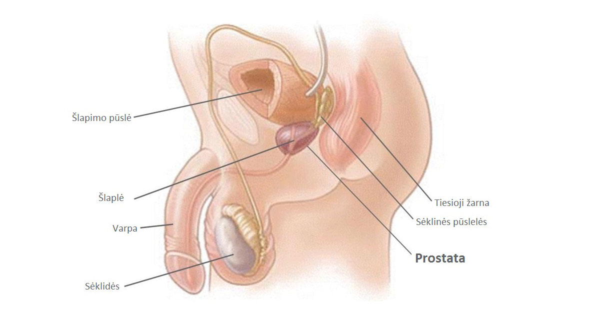 Dažniausiai pasitaikančios prostatos ligos ir erekcijos sutrikimai