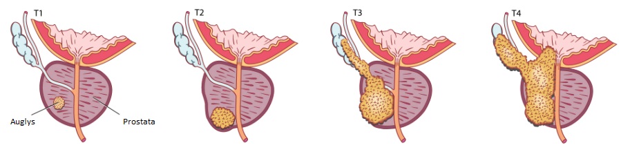 prostatito simptomų erekcija kiek raumenų ant varpos